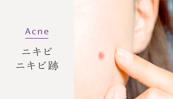 Acne ニキビ・ニキビ跡