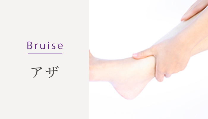 Bruise アザ