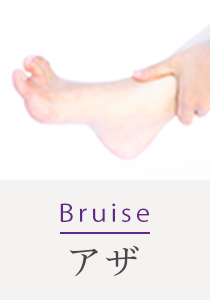 Bruise アザ